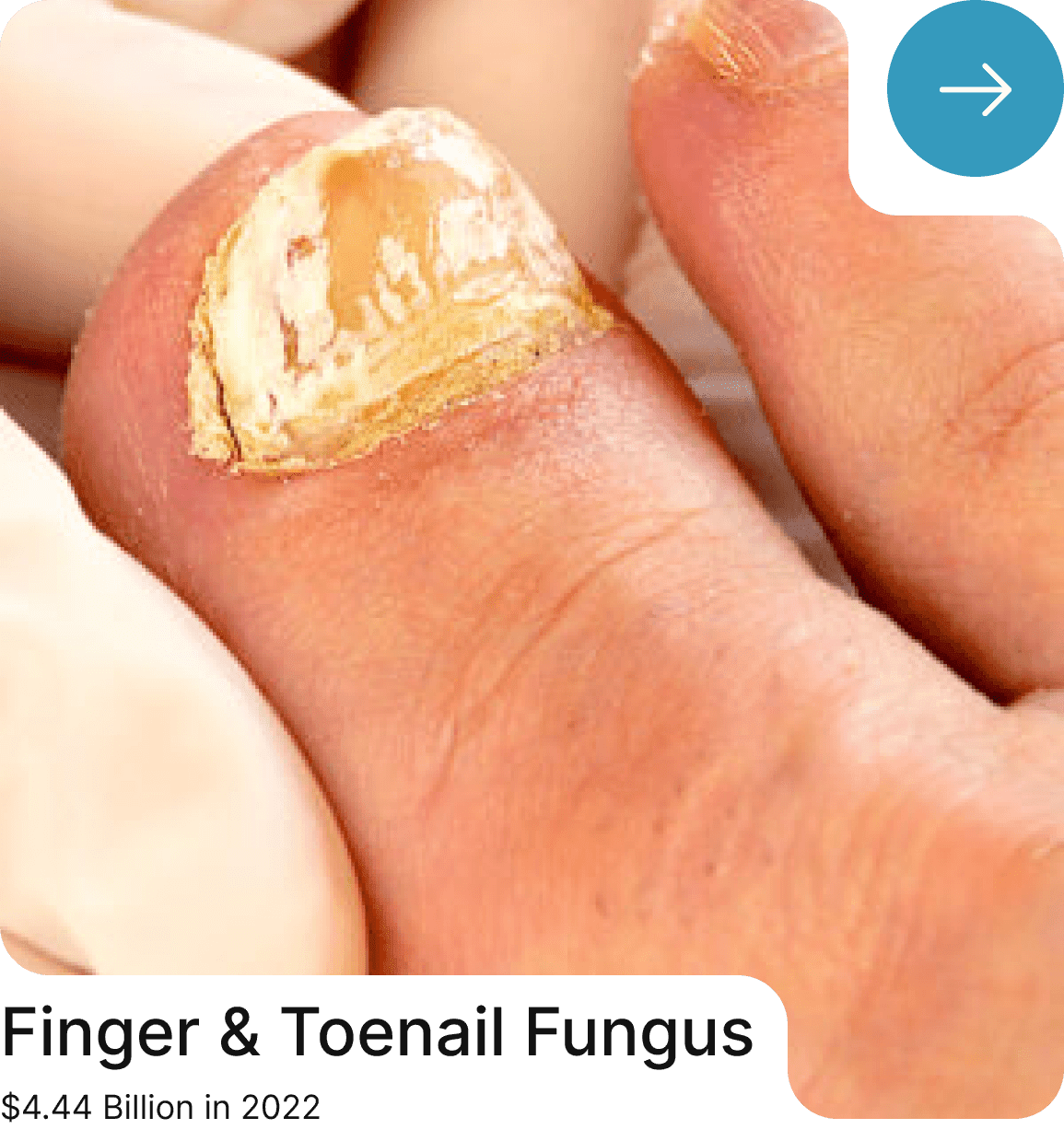 Finger & Toenail Fungus Treatment
