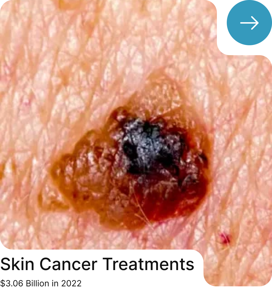 Skin-Cancer Treatment