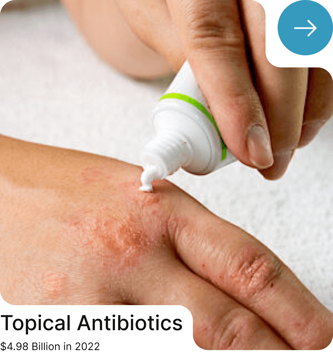 Topical Antibiotics